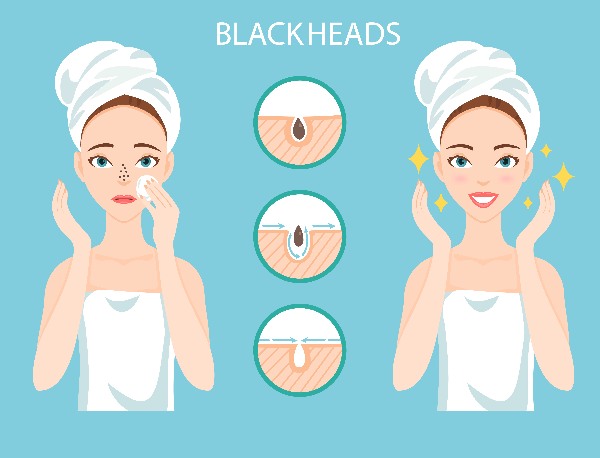 How do you get rid of blackheads