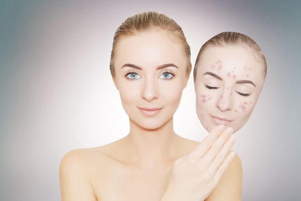 prevention of skin hyperpigmentation