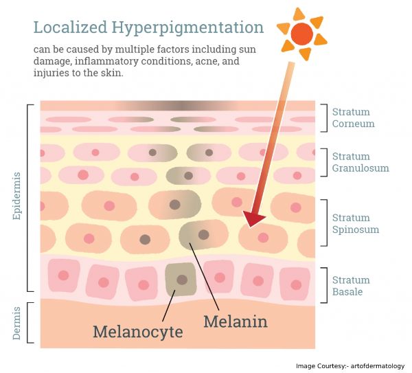 what causes hyperpigmentation