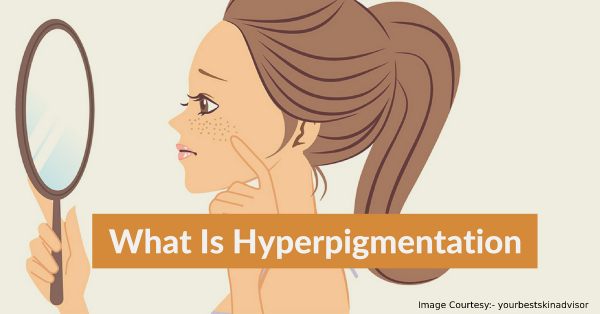 what is hyperpigmentation