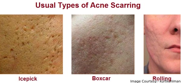 Know The Different Types Of Acne Scars And Know How To Treat Them