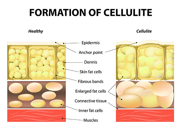Виды целлюлита с фото