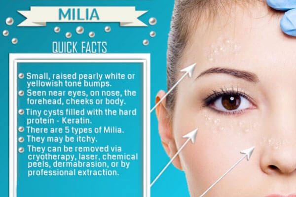 milia-under-eyes-complete-guide-preventive-and-measures