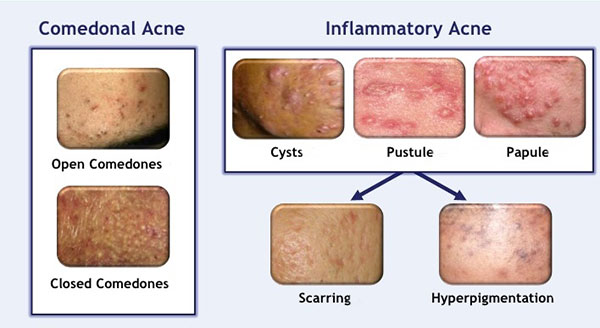 Hyperpigmentation From Acne: Necessary Treatment And Warnings