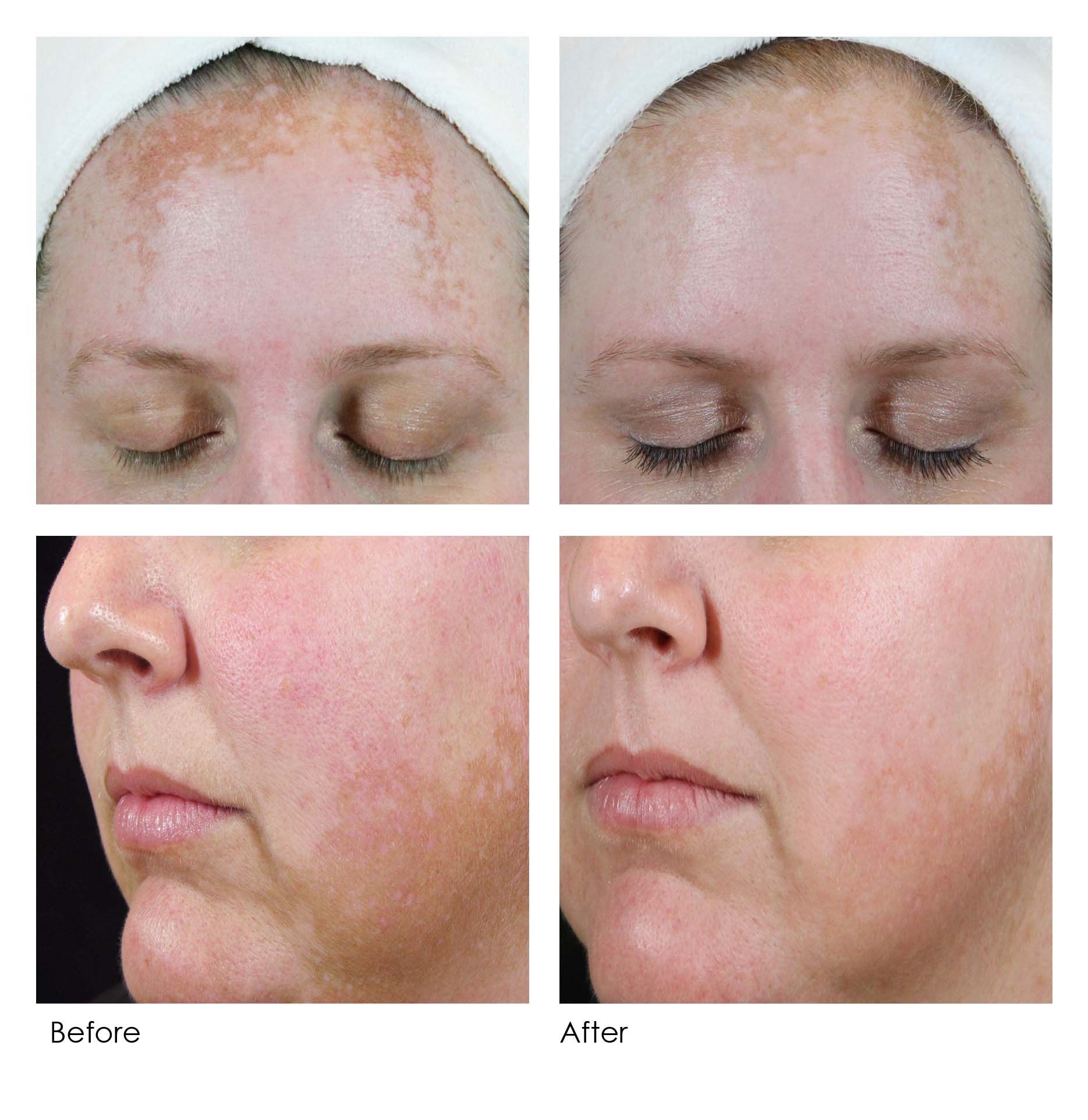 Dermaquest Skinbrite Serum Before and After Pictures