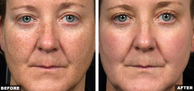 Tepezcohuite Cream Before and After Image