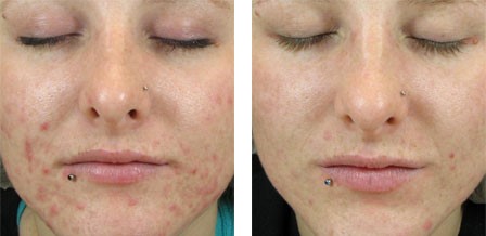 Dermaquest Dermaclear Cleanser Before and After